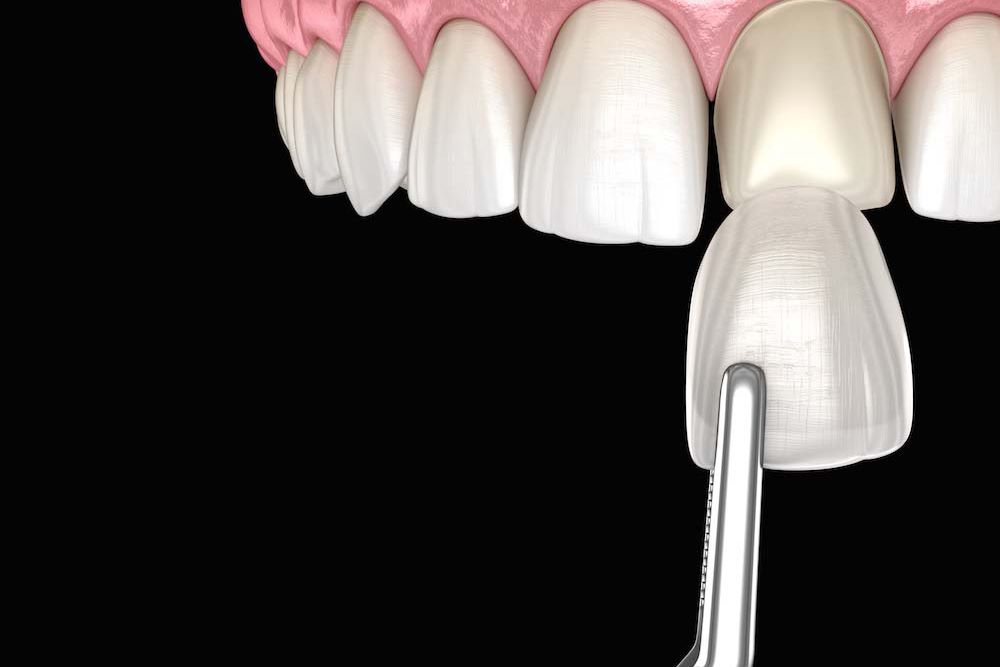 Gambar Veneer 1