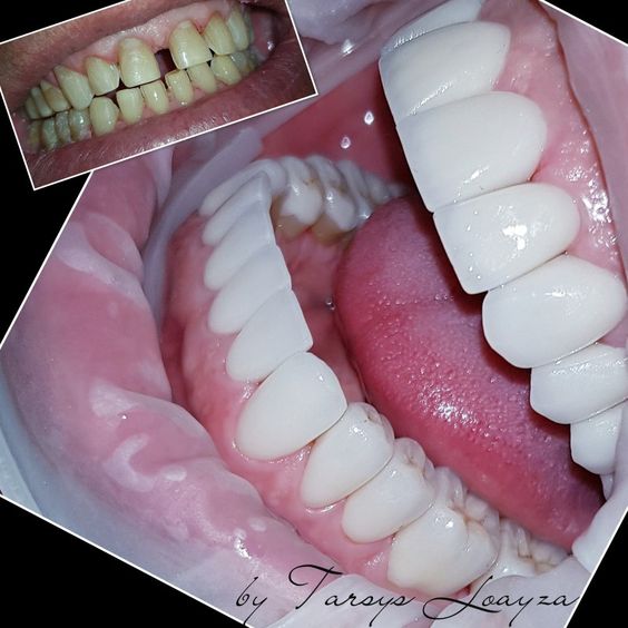 Gambar Veneer 2